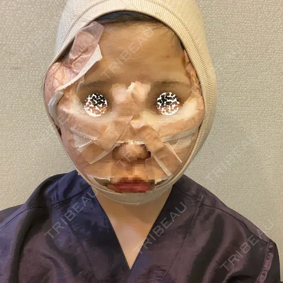 骨削り（頬） / 脂肪吸引（顔） / ボトックス（エラ・小顔） / ボトックス（ふくらはぎ） / ヒアルロン酸注入（額） / ボトックス（肩） RG整形外科（旧リオン整形外科） DAY 0 メイン用