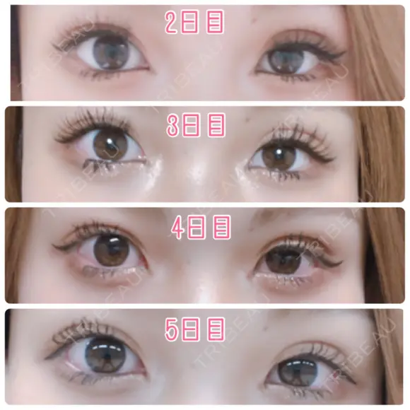 二重埋没 / 上まぶたの脂肪取り TCB東京中央美容外科 江坂院 DAY 6 メイン用