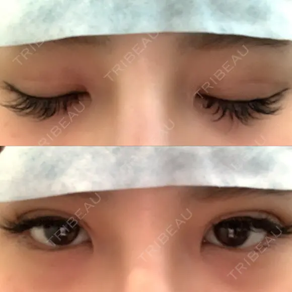 二重埋没 湘南美容歯科 大阪心斎橋院 DAY 1 メイン用