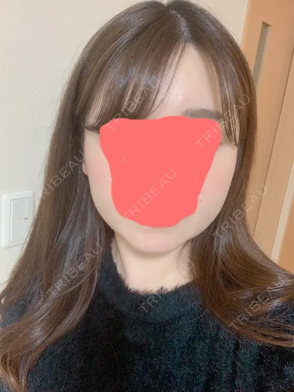 糸リフト / 骨切り（あご） / 骨削り（エラ） / 骨削り（頬） / 脂肪吸引（顔） RG整形外科（旧リオン整形外科） DAY 35 メイン用