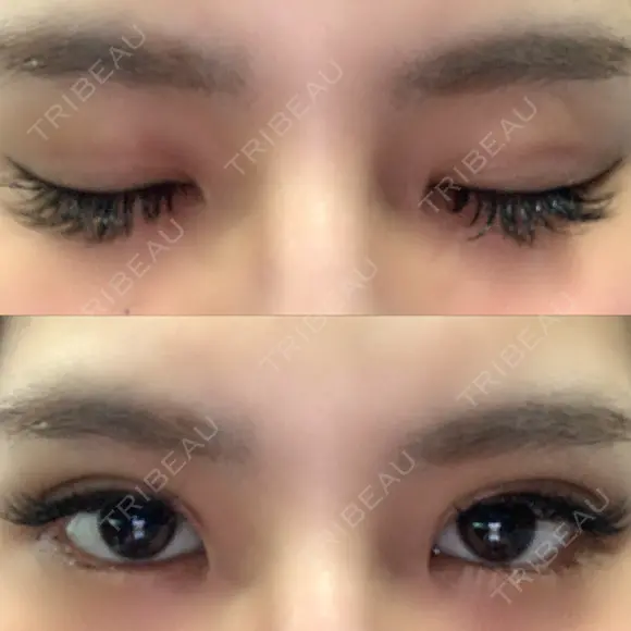 二重埋没 湘南美容歯科 大阪心斎橋院 DAY 1 メイン用