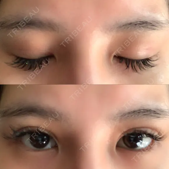 二重埋没 湘南美容歯科 大阪心斎橋院 DAY 2 メイン用