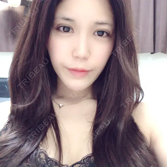 二重埋没 / 目頭切開 / 目尻切開 RG整形外科（旧リオン整形外科） DAY 27 メイン用