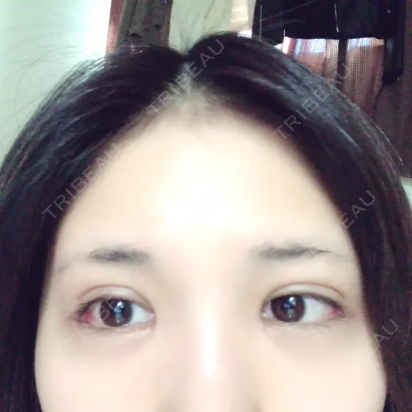 二重埋没 / 目頭切開 / 目尻切開 RG整形外科（旧リオン整形外科） DAY 27 メイン用