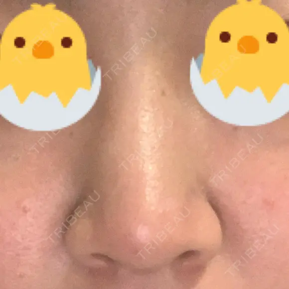 鼻尖形成（切開） / 鼻尖縮小 / ヒアルロン酸注入（鼻） 東京ヒルズクリニック 新宿院 DAY 59 メイン用