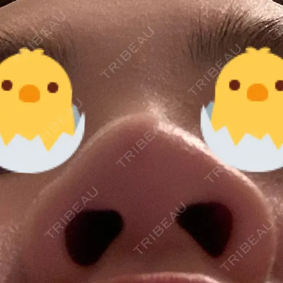 鼻尖形成（切開） / 鼻尖縮小 / ヒアルロン酸注入（鼻） 東京ヒルズクリニック 新宿院 DAY 59 メイン用