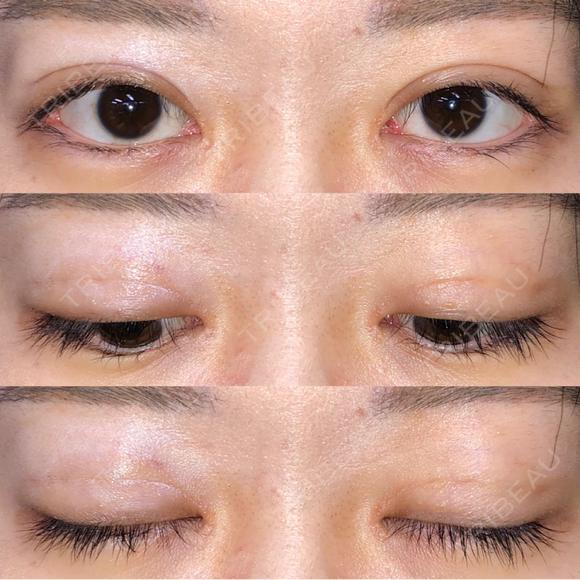 眼瞼下垂（切開） / その他（目元） / 目尻切開 / 自然癒着法 POP美容整形クリニック DAY 40 メイン用
