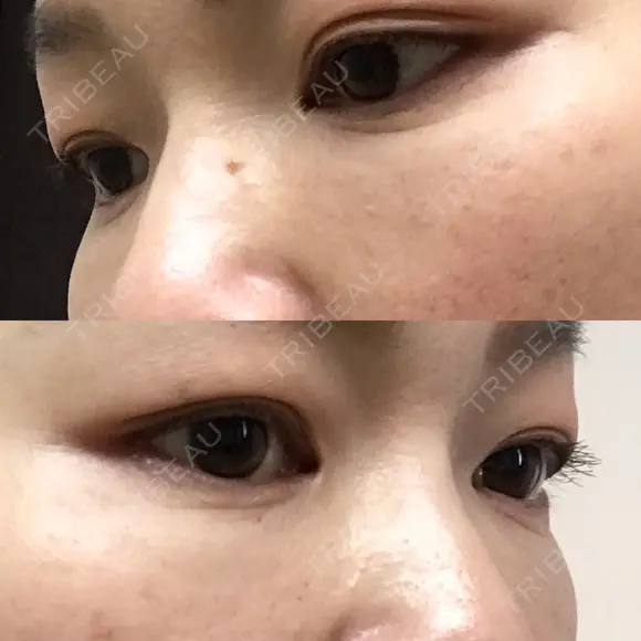 下まぶたたるみ取り セオリークリニック DAY 72 メイン用