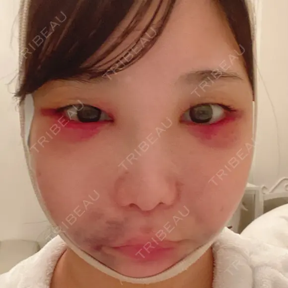 骨削り（頬） / 脂肪吸引（顔） / ボトックス（エラ・小顔） / ボトックス（ふくらはぎ） / ヒアルロン酸注入（額） / ボトックス（肩） RG整形外科（旧リオン整形外科） DAY 3 メイン用