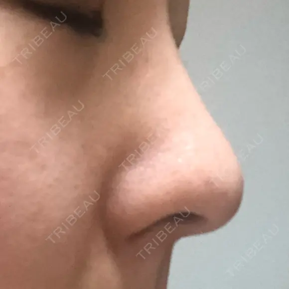 スレッドノーズ キップン整形外科 DAY 1 メイン用