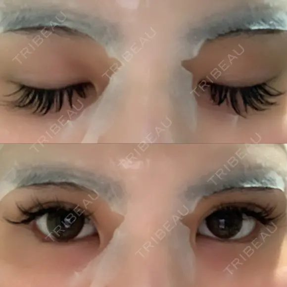 二重埋没 湘南美容歯科 大阪心斎橋院 DAY 4 メイン用