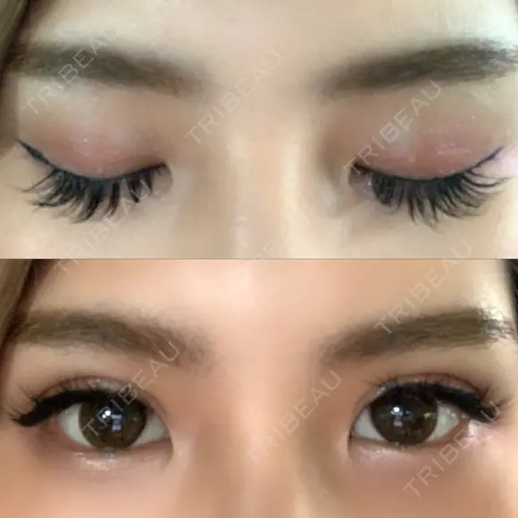 二重埋没 湘南美容歯科 大阪心斎橋院 DAY 4 メイン用