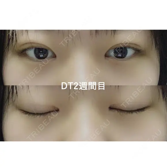 二重埋没 マーブル美容整形外科 DAY 15 メイン用