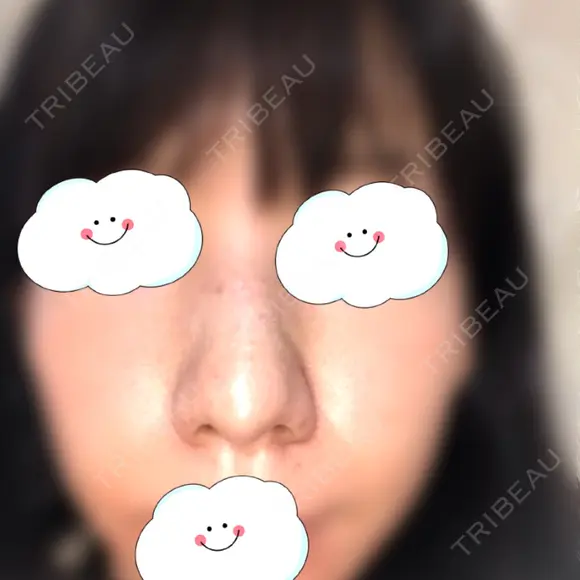 鼻尖形成（切開） / 軟骨移植 白山クリニック 大分 DAY 28 メイン用