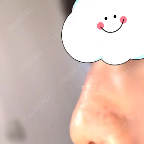 鼻尖形成（切開） / 軟骨移植 白山クリニック 大分 DAY 28 メイン用