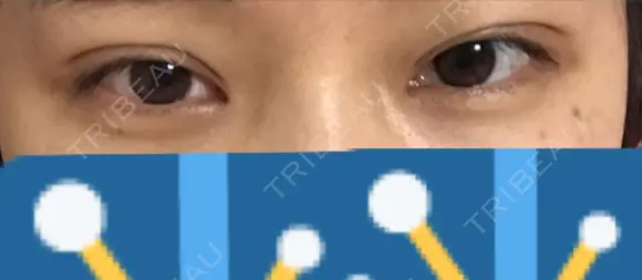 二重埋没 共立美容外科 大分院 DAY 0 メイン用