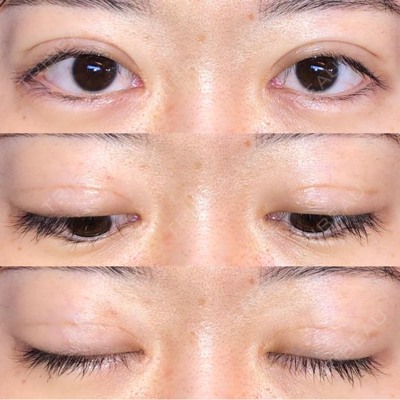 眼瞼下垂（切開） / その他（目元） / 目尻切開 / 自然癒着法 POP美容整形クリニック DAY 43 メイン用