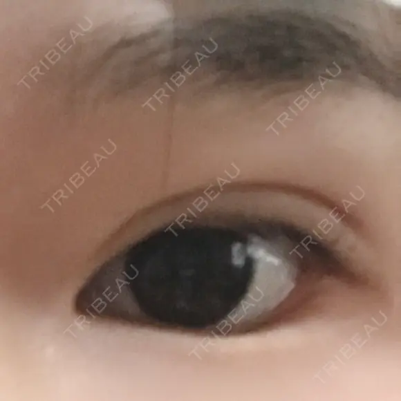 二重埋没 メディカルビューティセンター DAY 0 メイン用