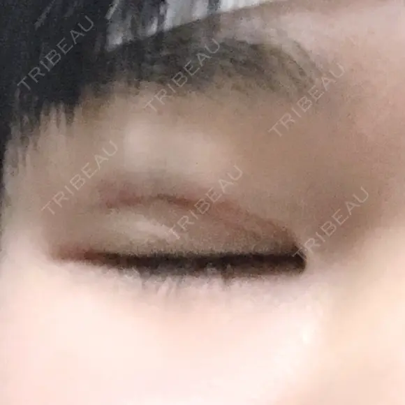 二重埋没 メディカルビューティセンター DAY 0 メイン用