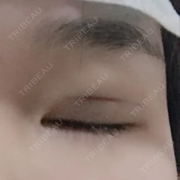 二重埋没 メディカルビューティセンター DAY 0 メイン用