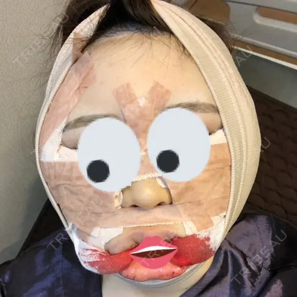 糸リフト / 骨削り（頬） / 脂肪吸引（顔） RG整形外科（旧リオン整形外科） DAY 0 メイン用