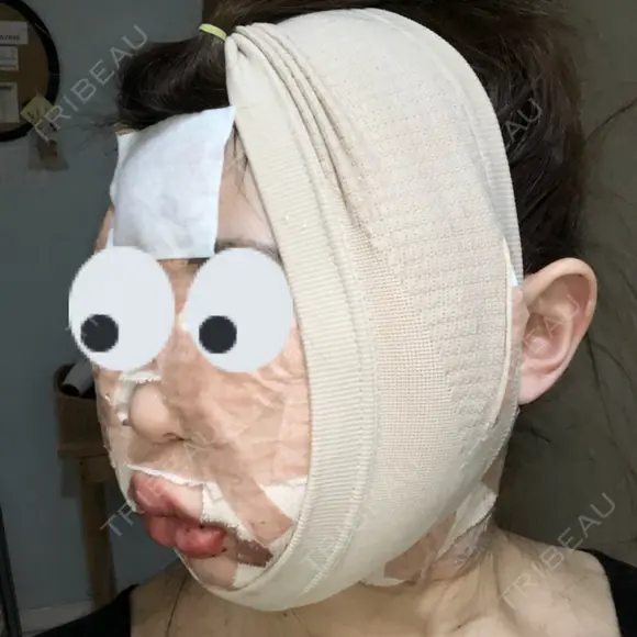 糸リフト / 骨削り（頬） / 脂肪吸引（顔） RG整形外科（旧リオン整形外科） DAY 0 メイン用