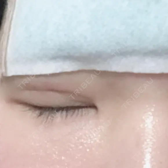 二重埋没 メディカルビューティセンター DAY 1 メイン用