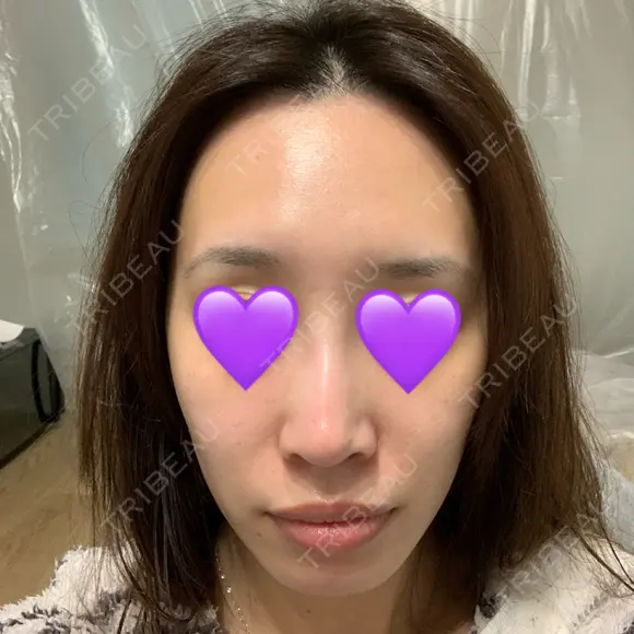 鼻尖形成（切開） / ヒアルロン酸注入（鼻） 東京ヒルズクリニック 新宿院 DAY 11 メイン用