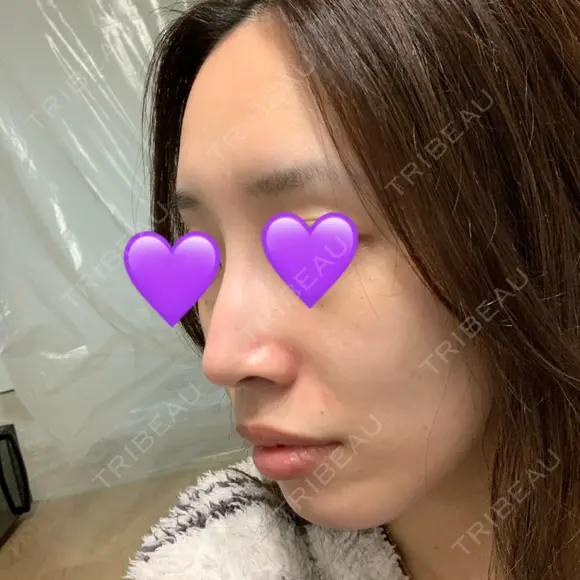 鼻尖形成（切開） / ヒアルロン酸注入（鼻） 東京ヒルズクリニック 新宿院 DAY 11 メイン用