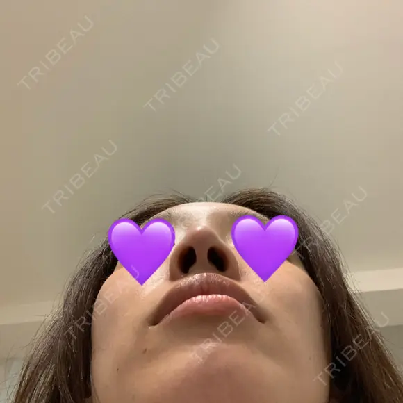 鼻尖形成（切開） / ヒアルロン酸注入（鼻） 東京ヒルズクリニック 新宿院 DAY 11 メイン用