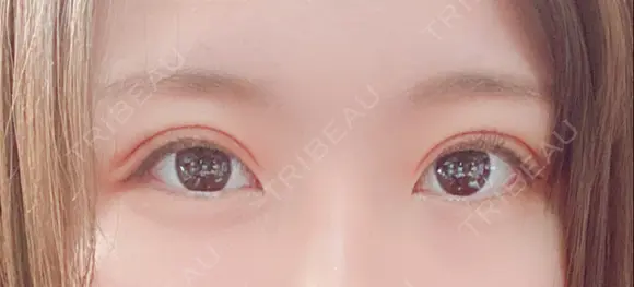 二重埋没 湘南美容クリニック 熊本院 AFTER メイン用