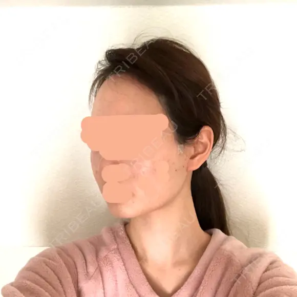 骨削り（頬） / 輪郭修正 リエンジャン整形外科 江南店 DAY 12 メイン用