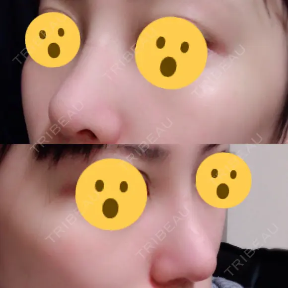 隆鼻術 / 鼻尖形成（切開） 湘南美容クリニック 名古屋院 DAY 11 メイン用