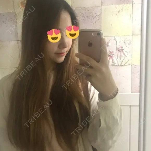 隆鼻術 / 鼻尖形成（切開） / 鼻中隔延長（切開） / 鼻孔縁挙上 ソウルリスタ整形外科 DAY 9 メイン用