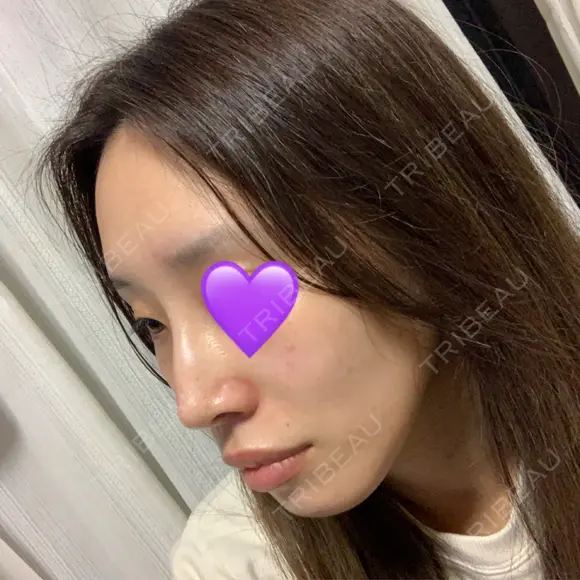 鼻尖形成（切開） / ヒアルロン酸注入（鼻） 東京ヒルズクリニック 新宿院 DAY 12 メイン用