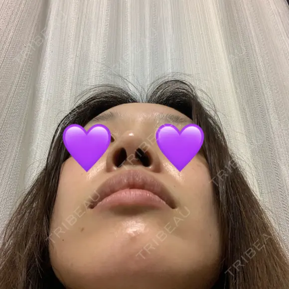 鼻尖形成（切開） / ヒアルロン酸注入（鼻） 東京ヒルズクリニック 新宿院 DAY 12 メイン用