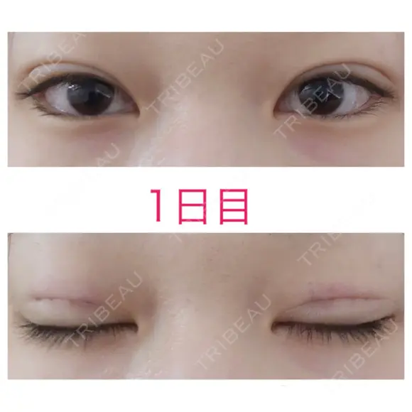 二重埋没 青山セレスクリニック 青山院 DAY 1 メイン用