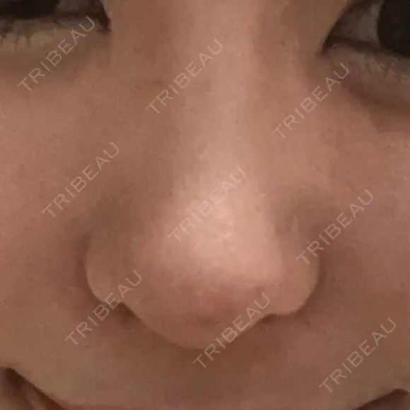 スレッドノーズ キップン整形外科 DAY 6 メイン用