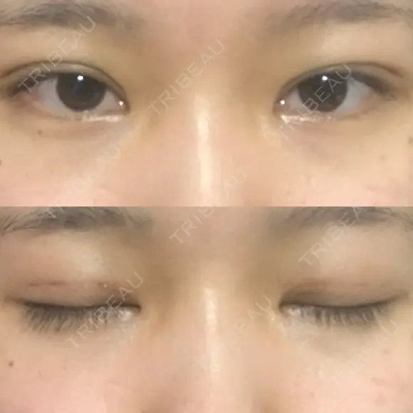 二重埋没 共立美容外科 大分院 AFTER メイン用