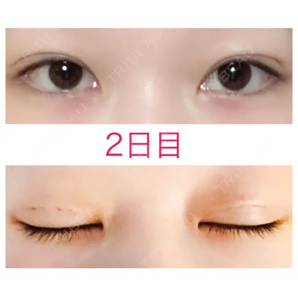 二重埋没 青山セレスクリニック 青山院 DAY 2 メイン用