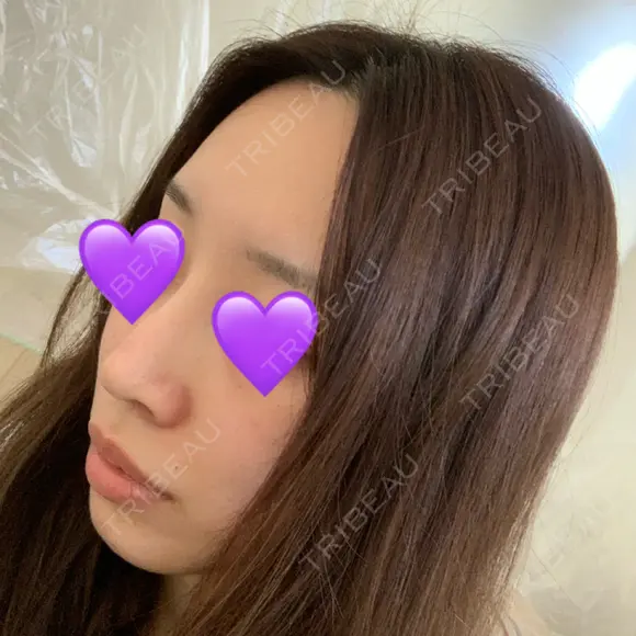 鼻尖形成（切開） / ヒアルロン酸注入（鼻） 東京ヒルズクリニック 新宿院 DAY 12 メイン用