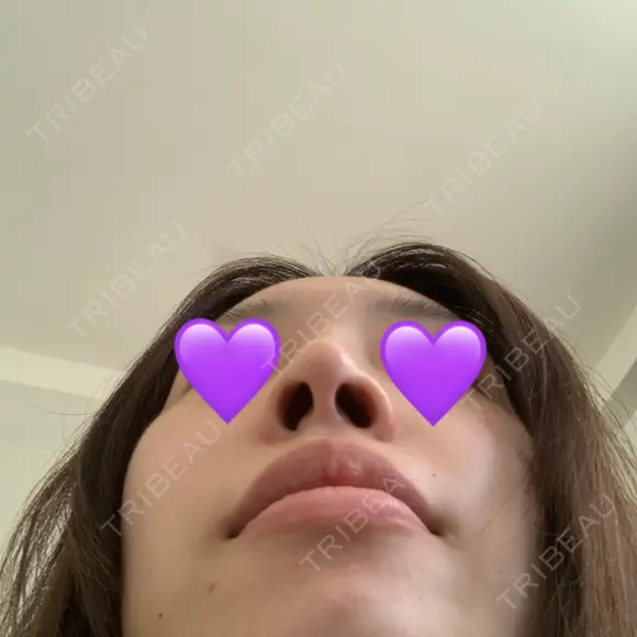 鼻尖形成（切開） / ヒアルロン酸注入（鼻） 東京ヒルズクリニック 新宿院 DAY 12 メイン用