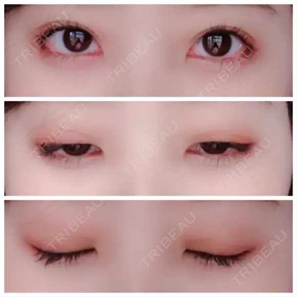 二重埋没 / 眼瞼下垂（切開） / クマ治療 / 下まぶたの脂肪取り THE MEDICAL SALON DAY 103 メイン用