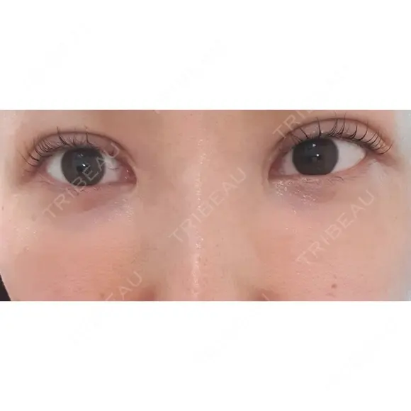 二重切開 CLASSY 仙台美容外科・美容皮膚科 AFTER メイン用