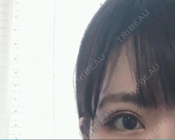 二重埋没 湘南美容クリニック 京都院 DAY 15 メイン用