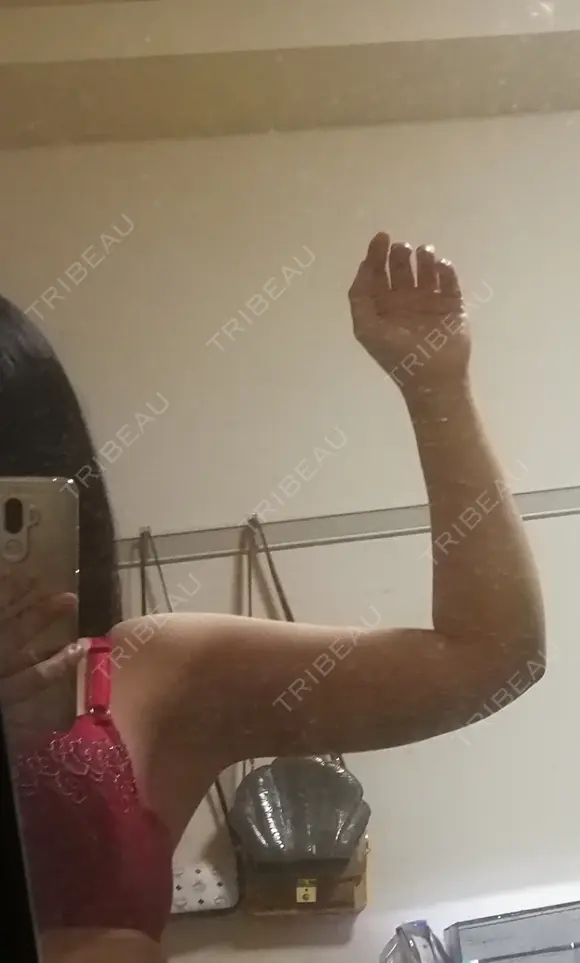 脂肪吸引（二の腕） プチパーティー医院 DAY 4 メイン用