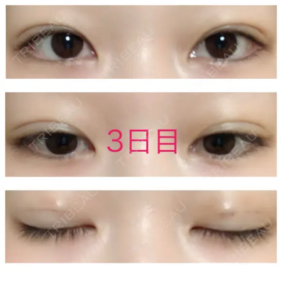 二重埋没 青山セレスクリニック 青山院 DAY 3 メイン用