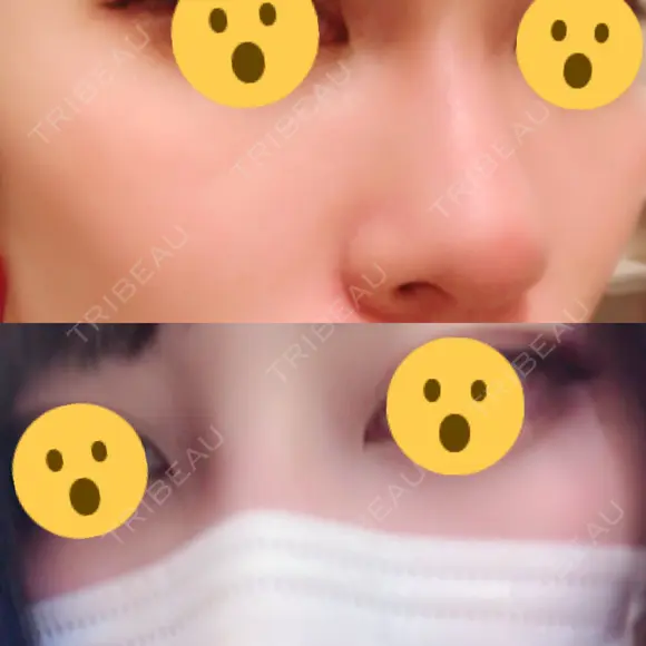 隆鼻術 / 鼻尖形成（切開） 湘南美容クリニック 名古屋院 DAY 14 メイン用