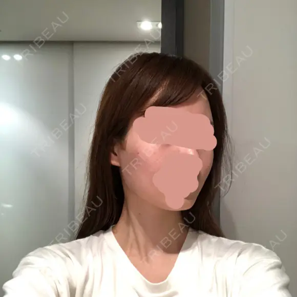 骨削り（頬） / 輪郭修正 リエンジャン整形外科 江南店 DAY 15 メイン用