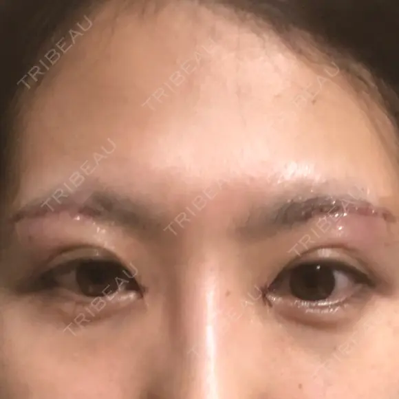 目頭切開 / 上まぶたたるみ取り 湘南美容クリニック 金沢院 DAY 2 メイン用